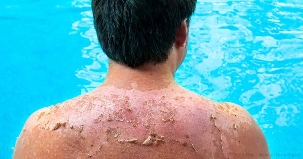 sunburn-fb